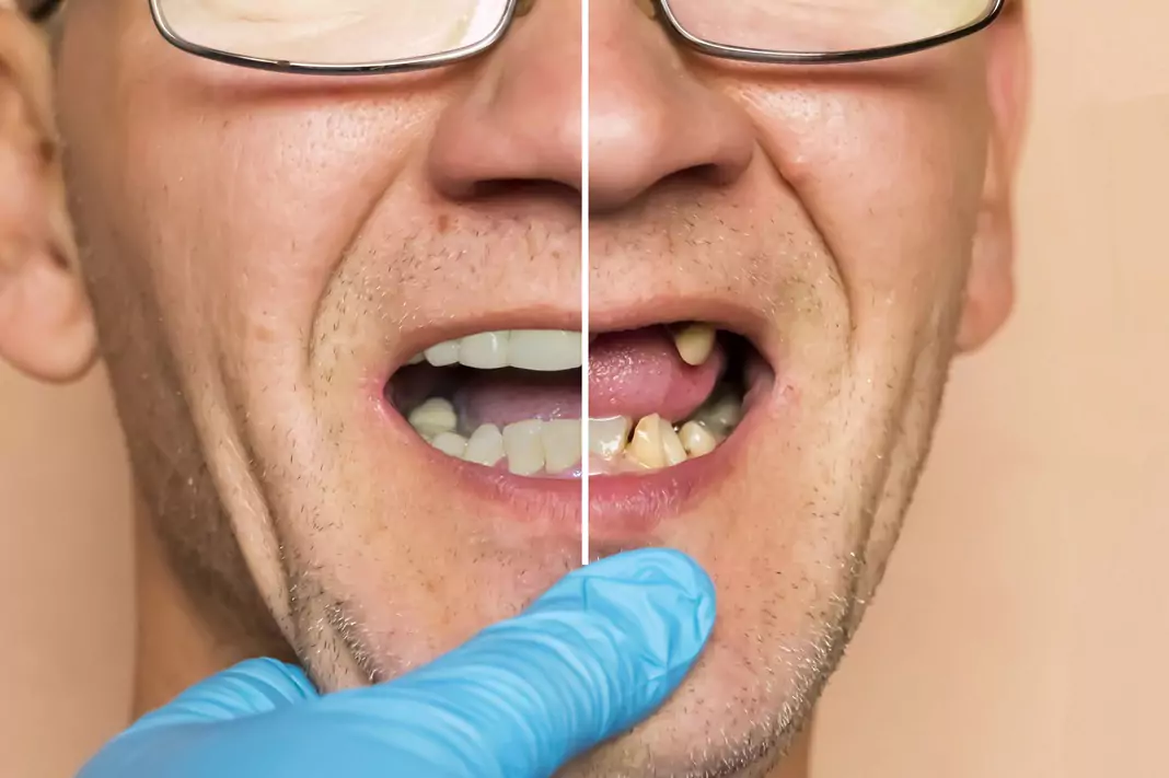 implant dentar